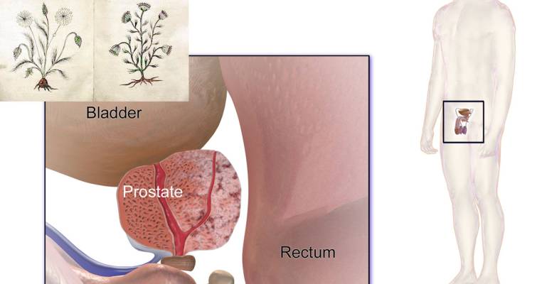 An enlarged prostate gland, benign prostatic hyperplasia (BPH), can interfere with urination, increasing the frequency and urge, or cause problems emptying the bladder
