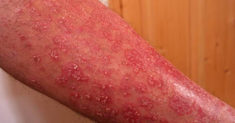 Read more: Treatment for Eczema &...